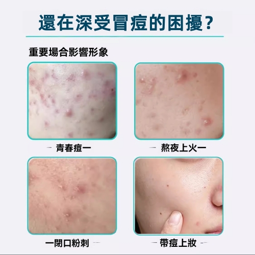 星星無痕痘痘貼